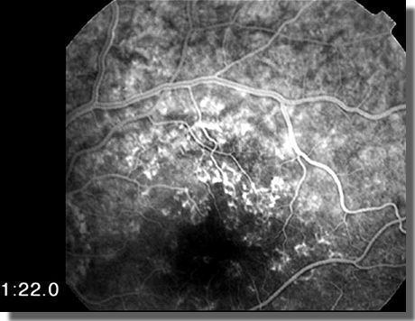 FA: late venous phase