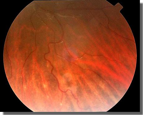 fundus image