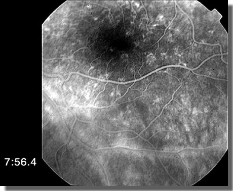 fluorescein angiogram