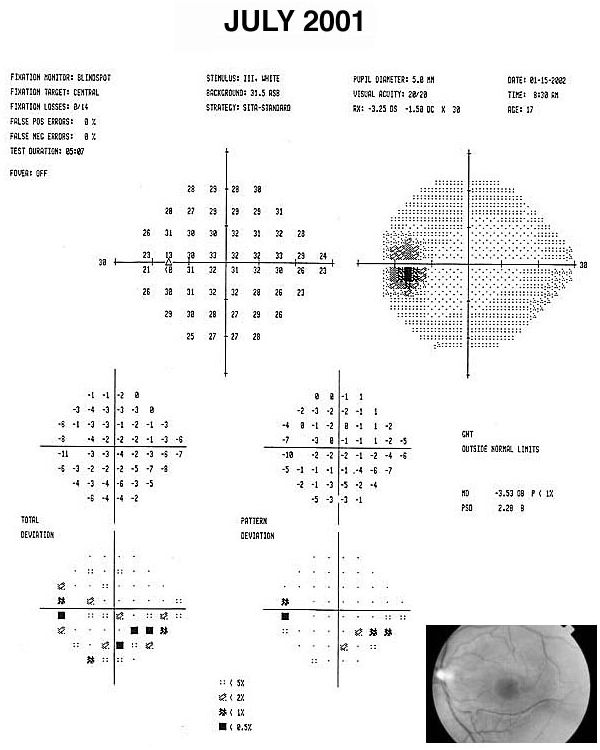 Humphrey visual field test