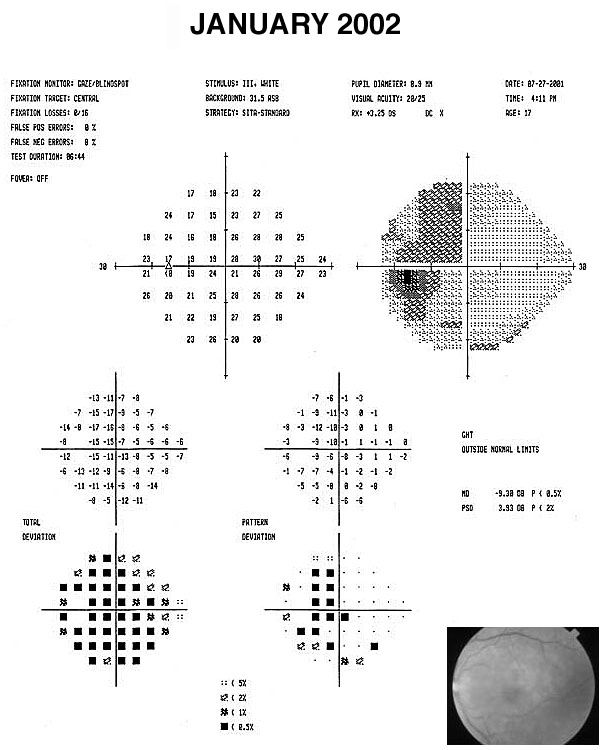 Humphrey visual field test