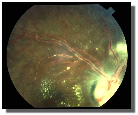 Different view of the right fundus