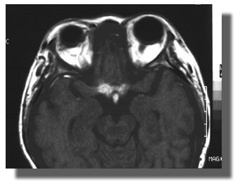 T1 axial view of the optic chiasm