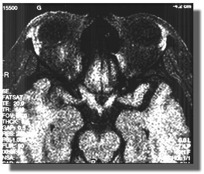 Fat-suppressed axial view