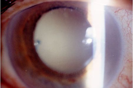 Slit lamp photograph OS