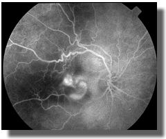 IVFA (40 sec)