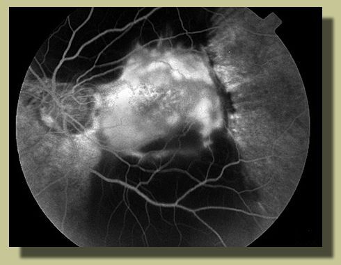 Fluorescein angiogram reveals subretinal hemorrhage OS