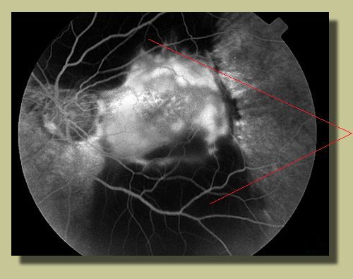 Fluorescein angiogram reveals subretinal hemorrhage OS