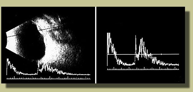 Echogram reveals retinal elevation and subretinal opacities OS