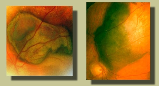 Image of subretinal hemorrhage and choroidal melanoma