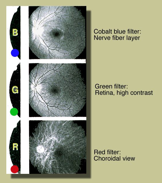 Umdnj Njms Ophthalmology Case Of The Month