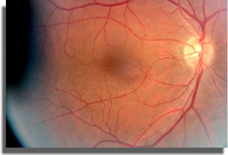 Fundus photograph OD