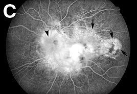 Fluorescein angiography OS