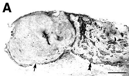 Histology of excised CNV