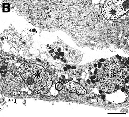 EM of excised CNV