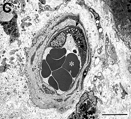 Histology of excised CNV