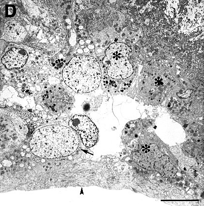 Histology of excised CNV