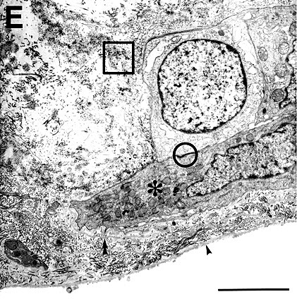 Histology of excised CNV