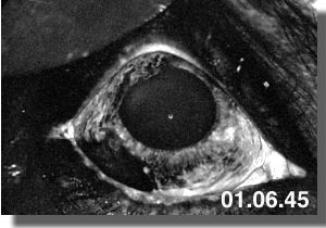 Fluorescein angiography:Mid-phase