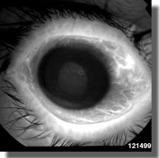 Fluorescein angiography OD