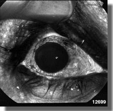 Fluorescein angiography OD