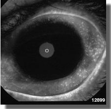 Fluorescein angiography OS