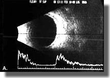 Echogram after surgery