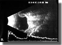 Echogram after surgery