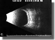 Echogram after surgery