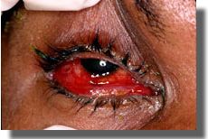 Appearance of conjunctiva