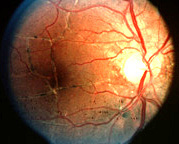 Fundus photograph OD