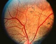 Fundus photograph OD