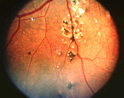 Fundus photograph OD