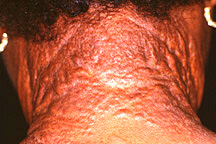 Back of the neck shows papular appearance 