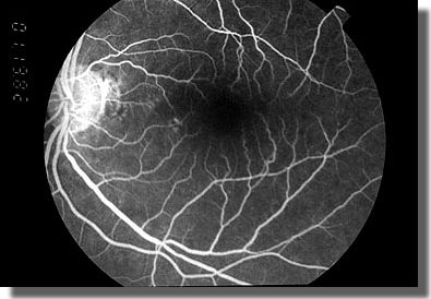 Arteriovenous Phase OS