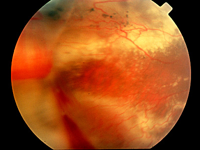 Fundus image OD