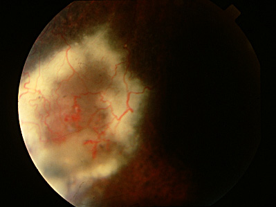 Fundus image OS