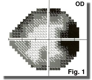 Visual field OD