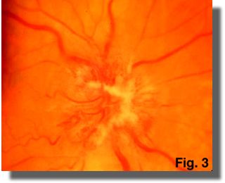 Fundus photograph OD