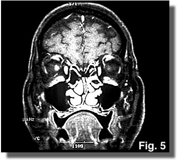 MRI of the head