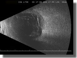 B scan OD: Longitudinal scan of the 7:30 meridian