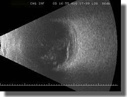 B scan OD: Transverse scan of the 6-o'clock meridian