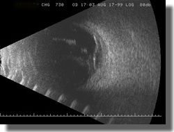 B scan OD: Transverse scan of the 7:30 meridian