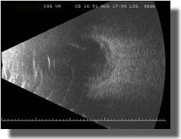 B scan OD: Vertical at the macula