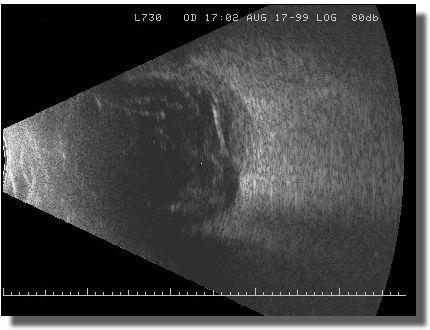 Echogram: Longitudinal Scan of the 7:30 Meridian