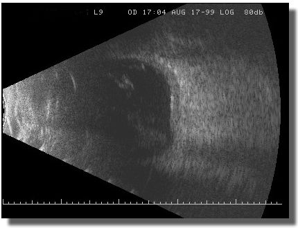 Echogram: Longitudinal Scan of the 9-O'Clock Meridian