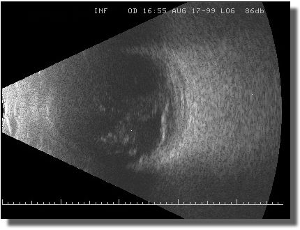 Echogram: Transverse Scan of the 6-O'Clock Meridian