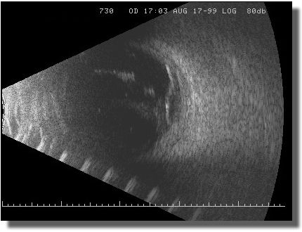 Echogram: Transverse Scan of the 7:30 Meridian