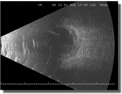 Echogram: Vertical at the Macula