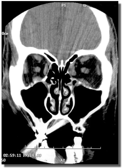 Postoperative CT scan